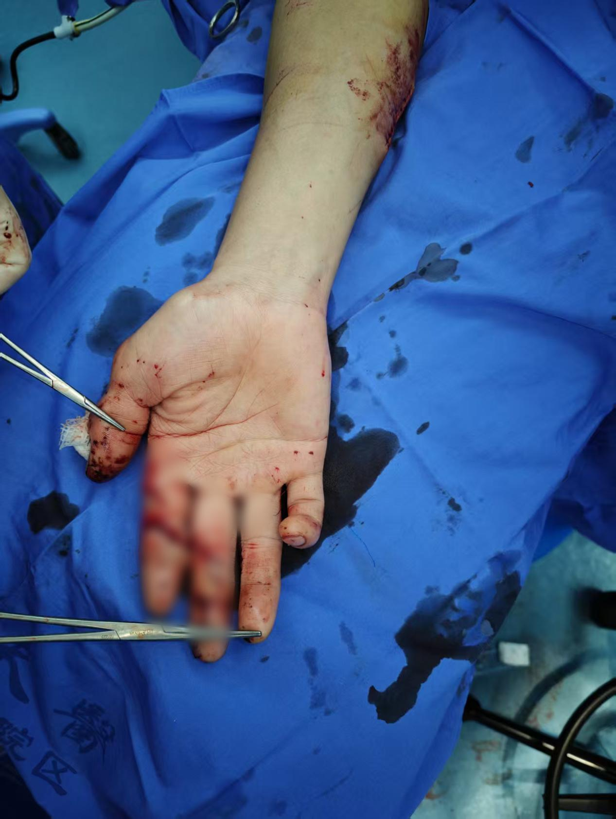 手术成功接上断指 配图1