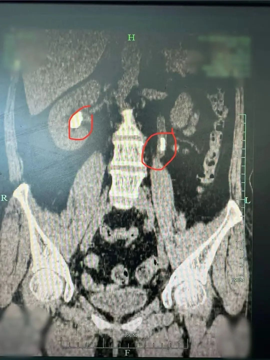 红圈内为双肾结石 配图1