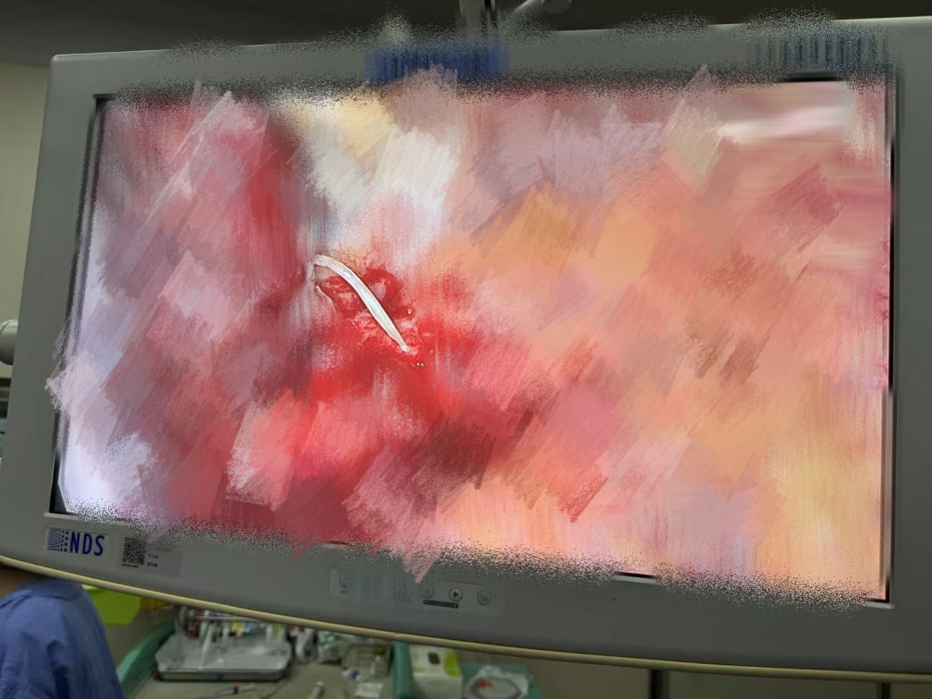 术中所见刺穿食管的鱼刺 配图2