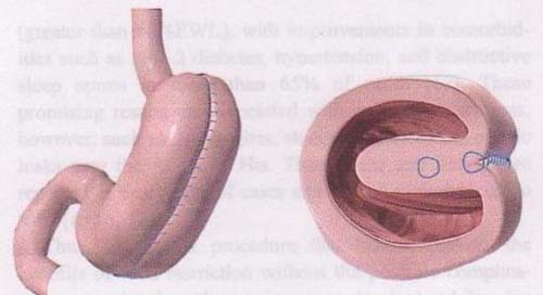 胃缝小减肥术 东北女士首次尝试