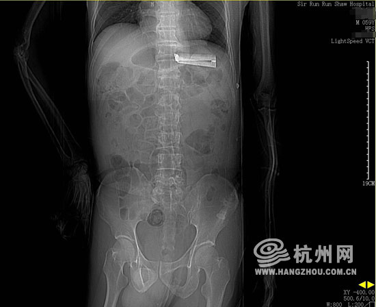 脑溢血病人误吞8.5厘米削皮刀获救 